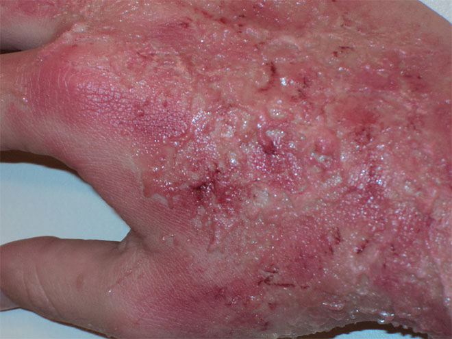 Химический ожог кожи