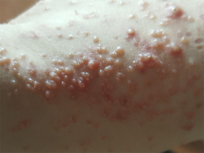 Лечение моллюсков на коже