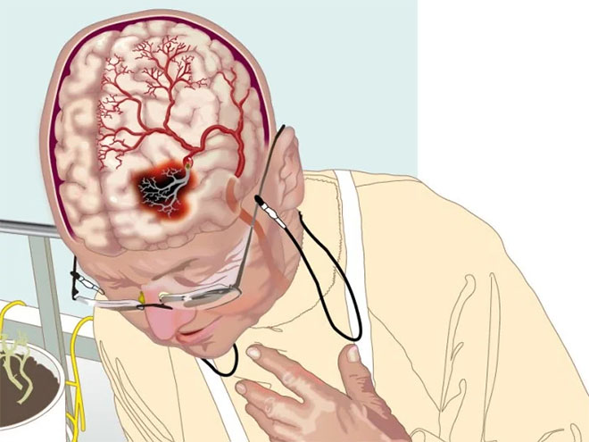 Qué enfermedades se pueden detectar con un tac cerebral